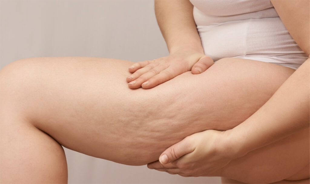 Cellulite Redefined Treatment | Cellulite Thighs, Buttock, Abdomen