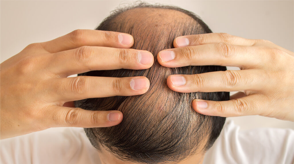 Hair Hyperstimulation Laser Therapy H2LT Singapore