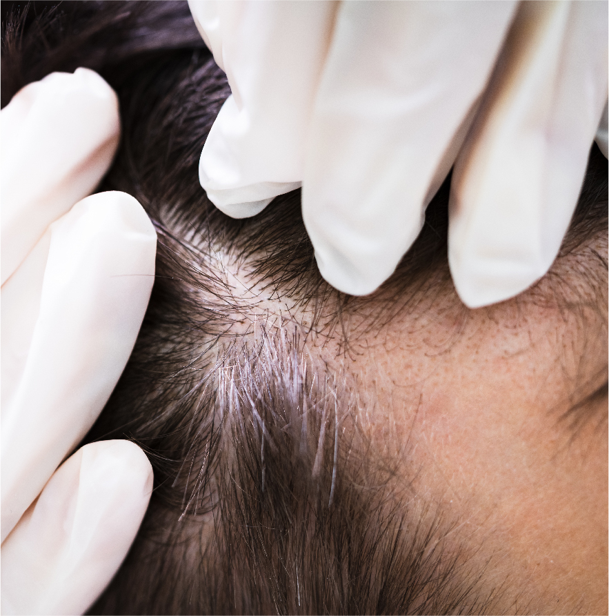 Hair Loss Treatment methods in Singapore