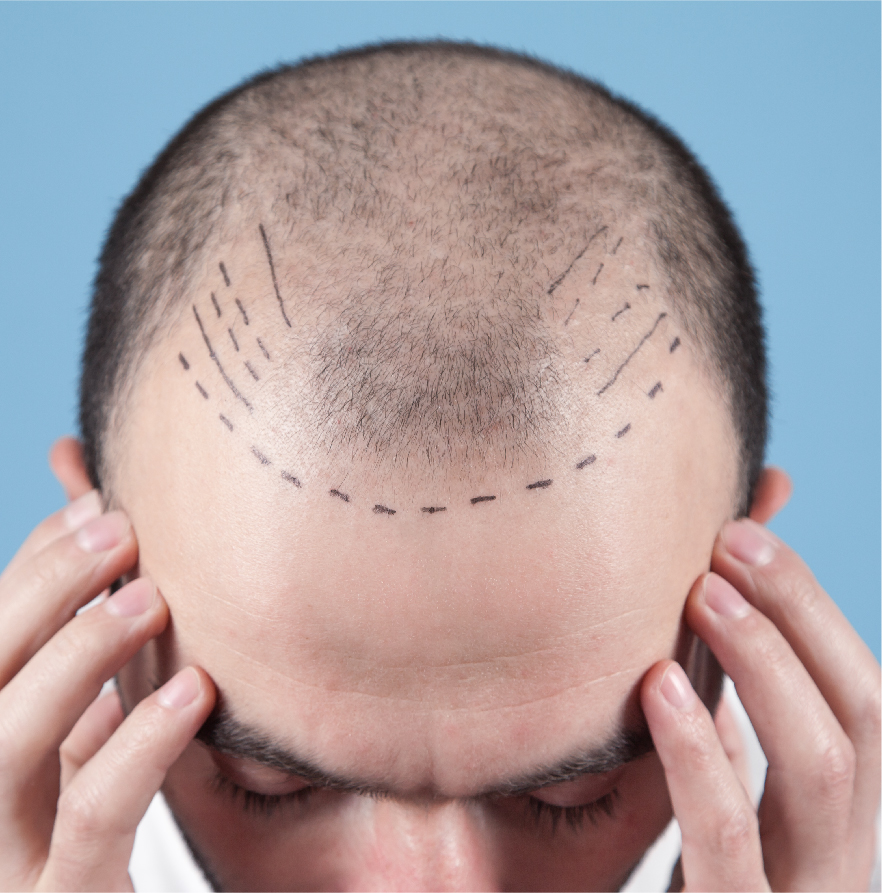 Hair Loss Treatment methods in Singapore