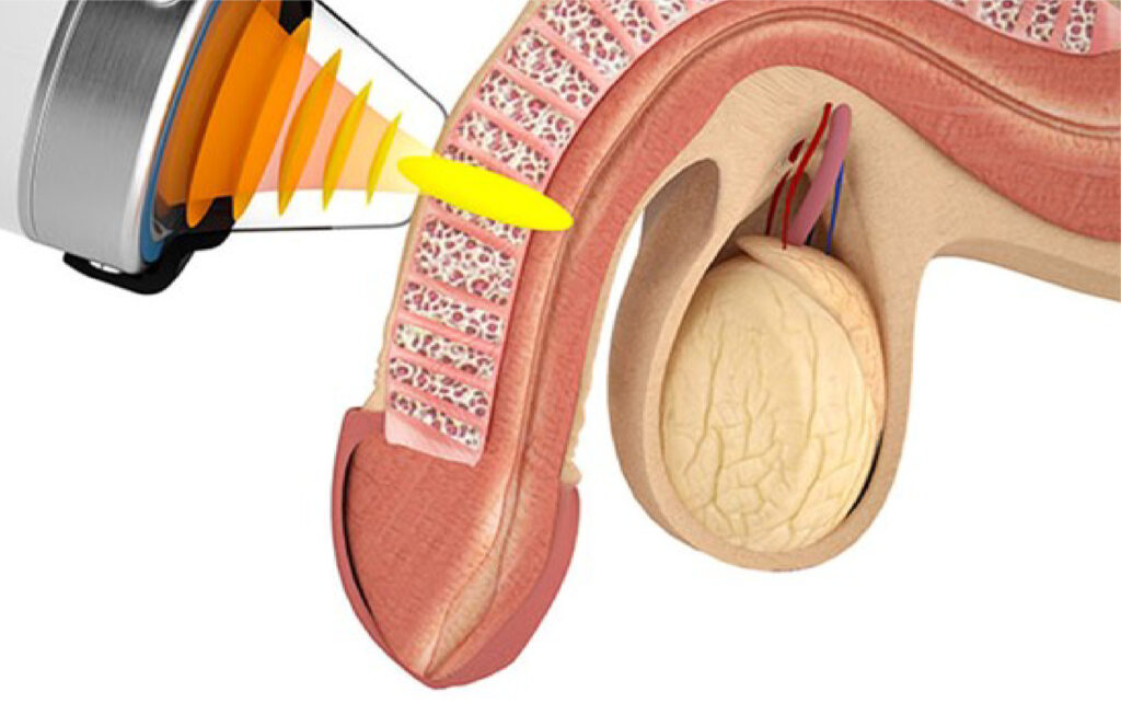 Erectile Dysfunction ED Treatment | ED Shock Therapy Near me