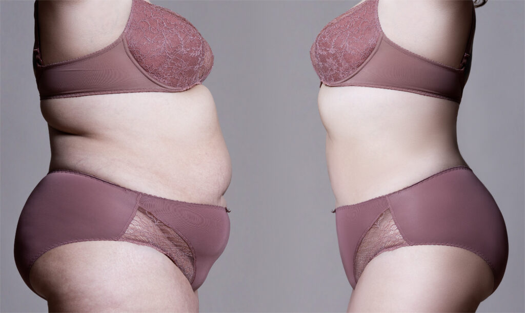 Svelte Touch - The Fat Recontouring Process