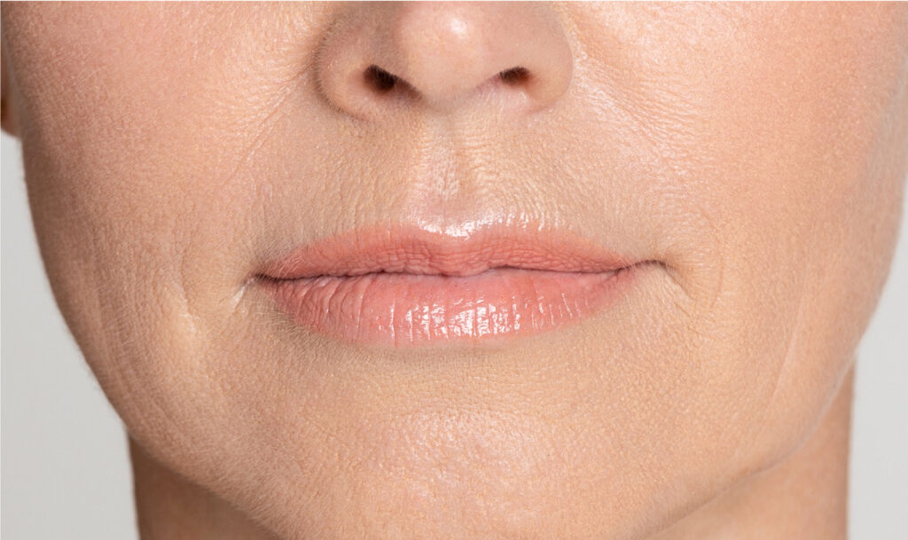 Rekindling The Lips With Lip Fillers