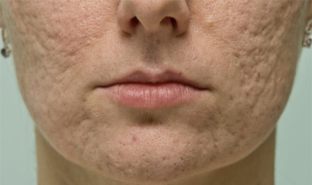 Scar Reconstruction: Treating Skin Scars