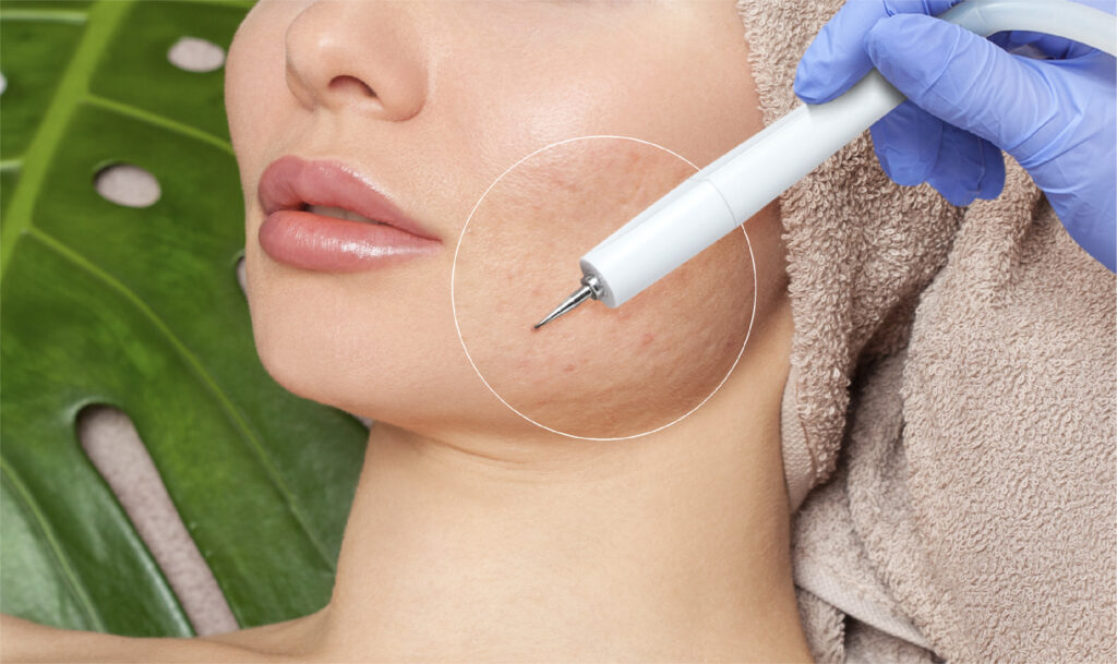 Rolling Scar Treatment | Subcision - Breaking underlying scar fibres