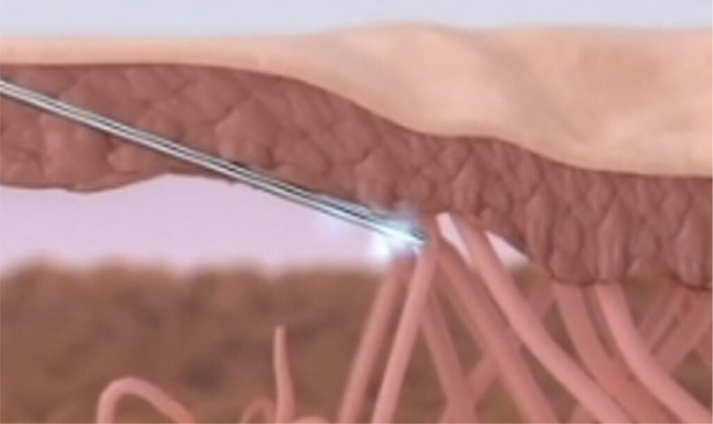 Rolling Scar Treatment | Subcision - Breaking underlying scar fibres