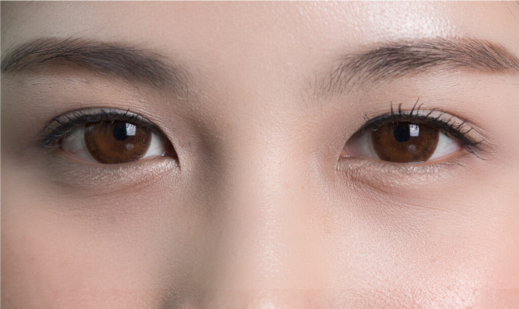 Tear trough fillers for dark circles | under eye hollowness treatment