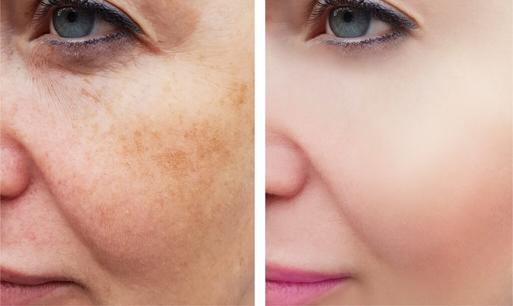 Pigmentation treatment on Face | PiQ Laser | Dr Sing Yong