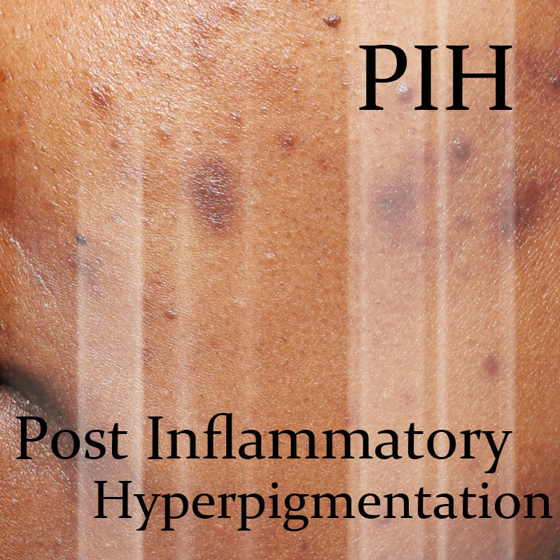 Post Inflammatory Hyperpigmentation Treatment