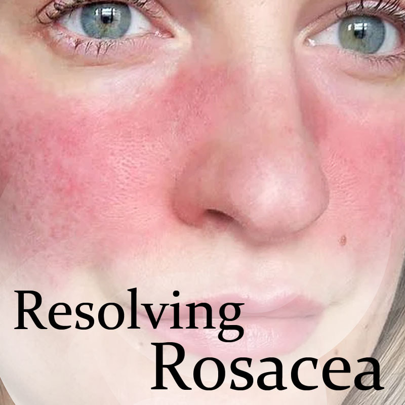 Resolving Rosacea | Laser treatment for rosacea