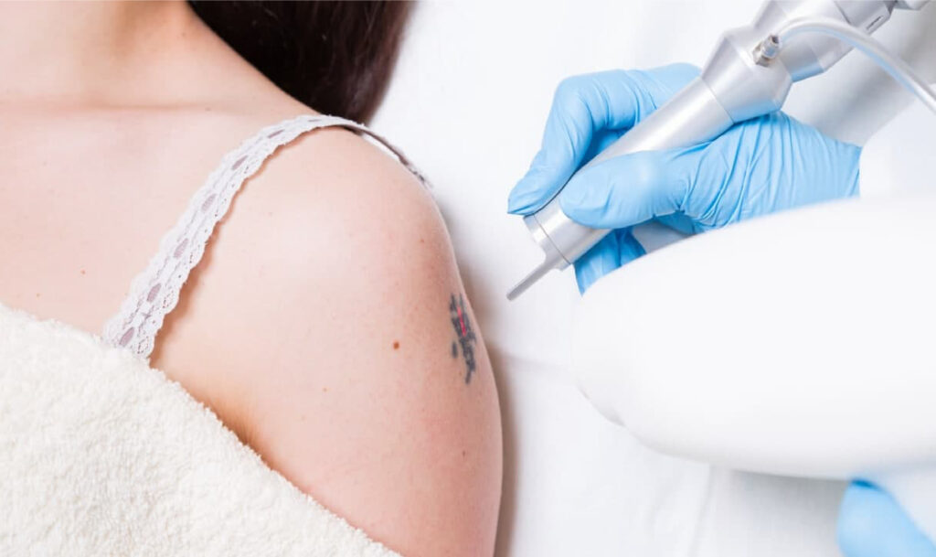 Tattoo Laser Removal Treatment Near Me