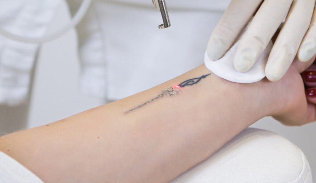 Tattoo Laser Removal Treatment Near Me