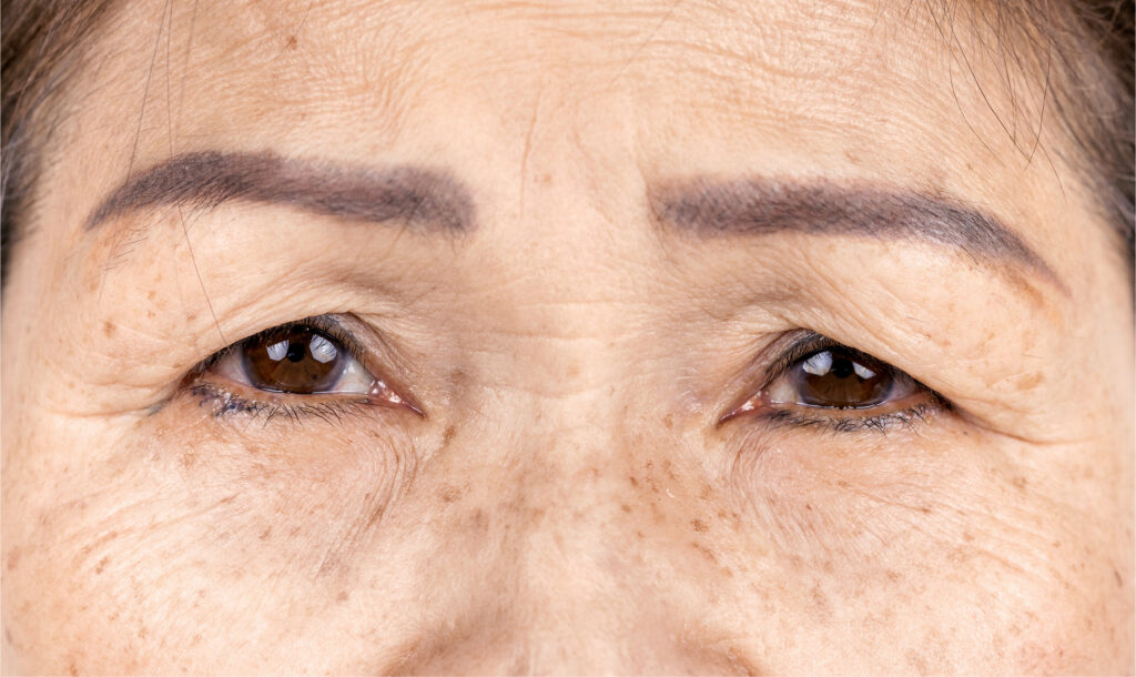 Wrinkles Prevention Botox for Wrinkles & Jawline contouring