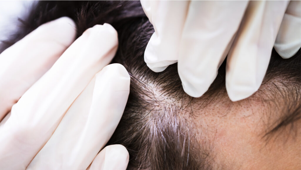 Anti Hair Loss Medications | Regenera Activa