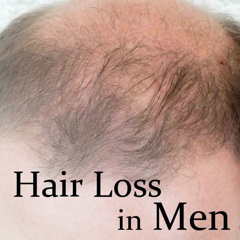 Hair loss in men | Androgenetic alopecia or thinning hair treatment