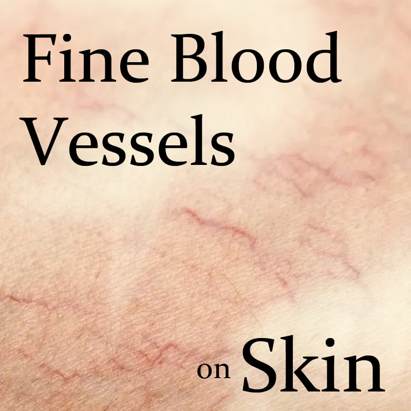 Removing Fine Blood Vessels on Skin | Telangiectasias treatment