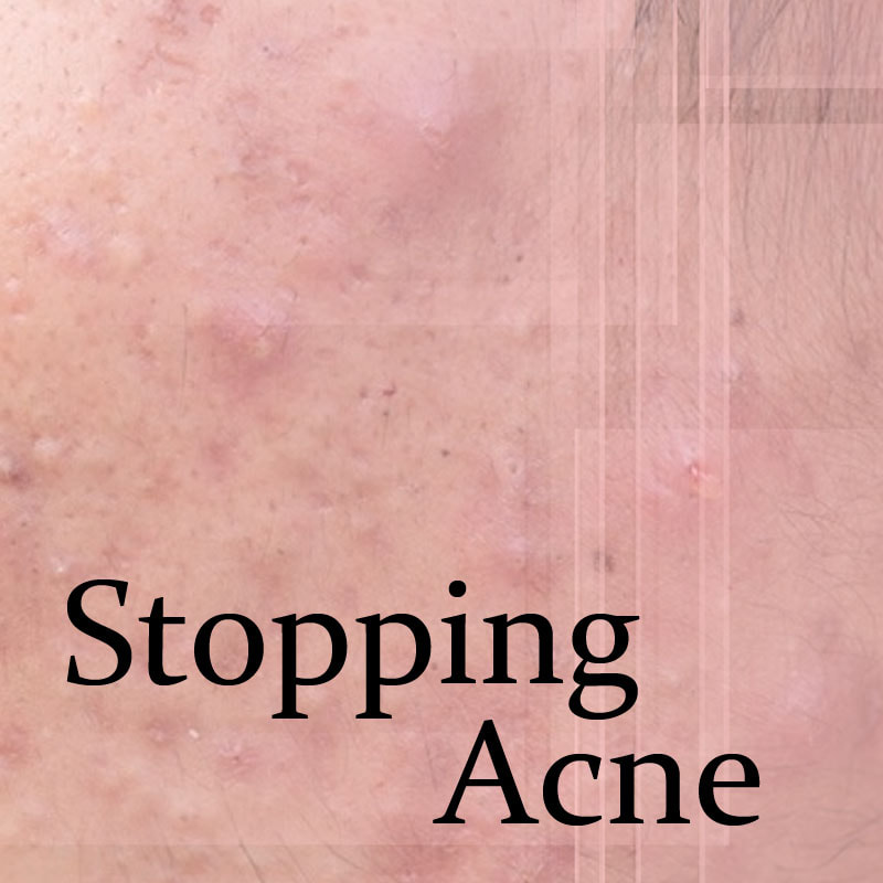 Stopping Acne Flares - Laser Pimple Treatment | Dr Sin Yong