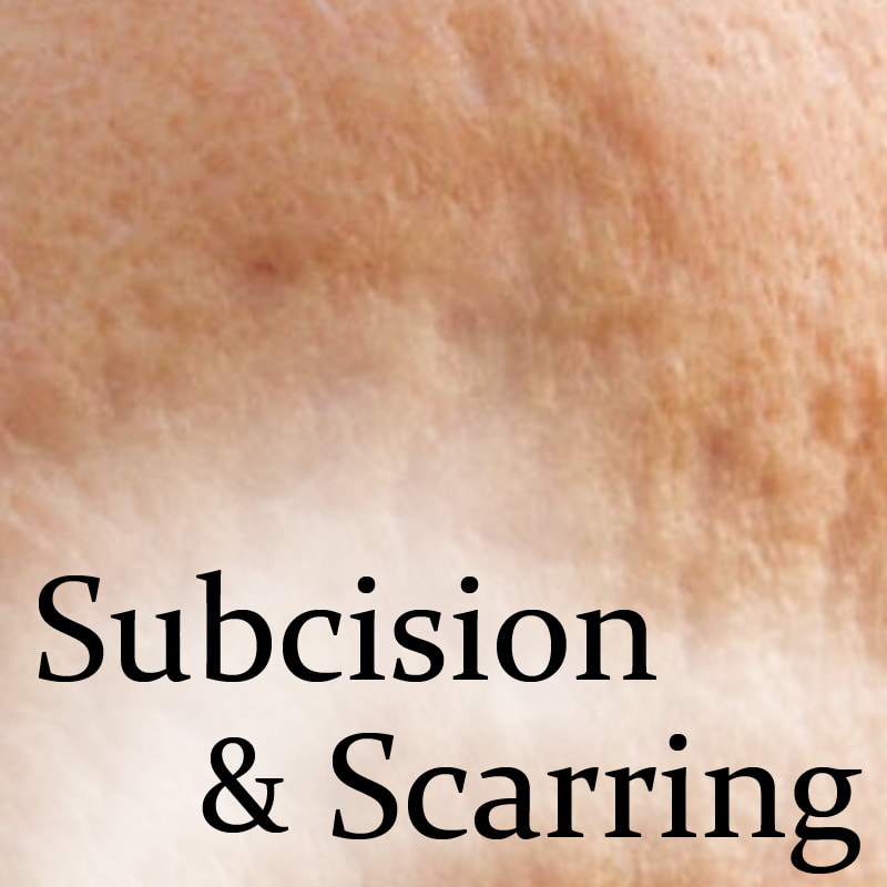 Subcision Treatment for Acne & rolling scars | Dr Sin Yong