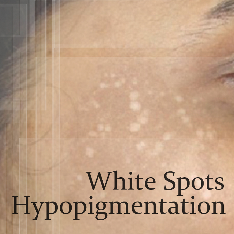 White Spots Hypopigmentation Causes & Treatments