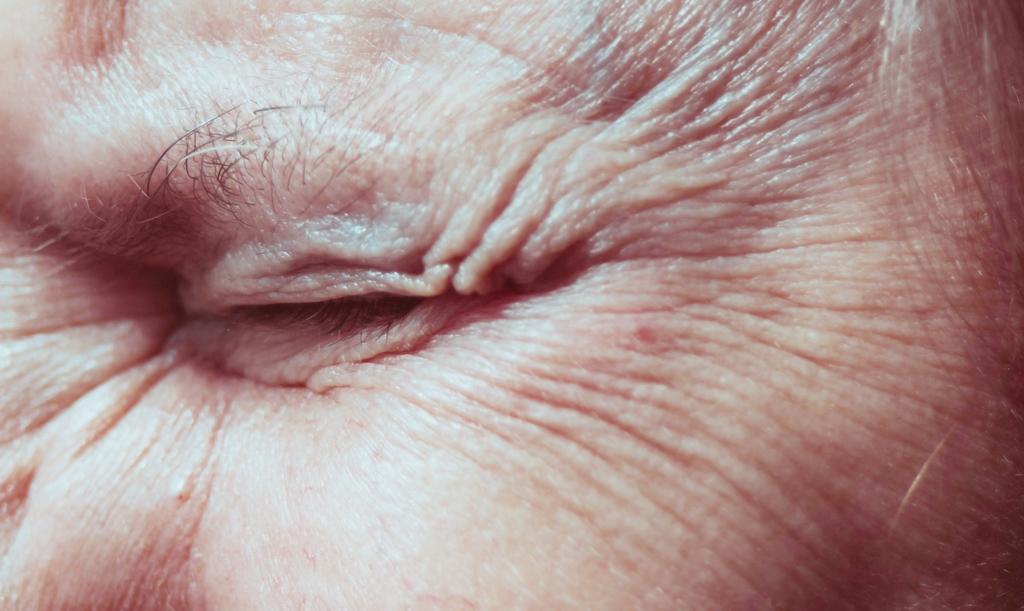 Wrinkles Prevention Botox for Wrinkles & Jawline contouring