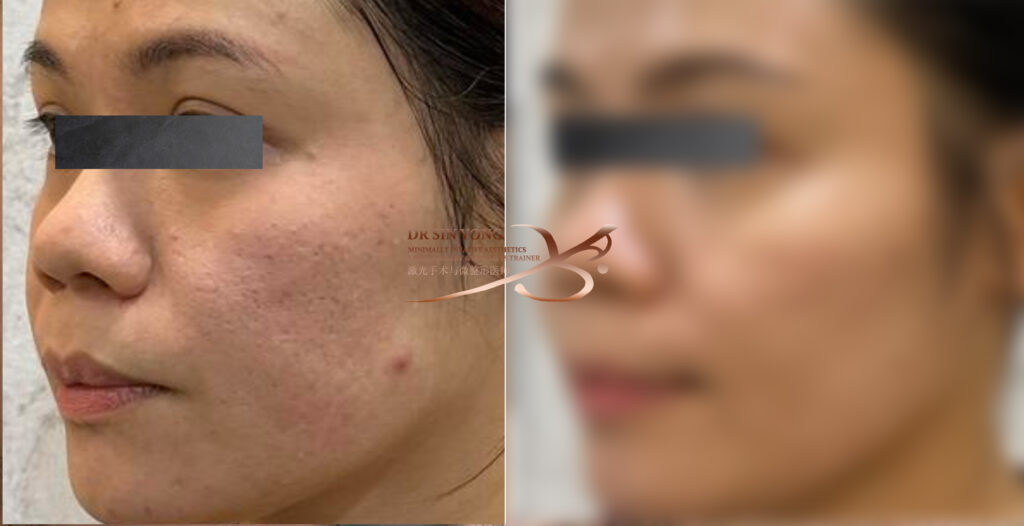 Tetra Pro Scar3 - Acne Scar Treatment - Boxcar, Icepick, Rolling Scars