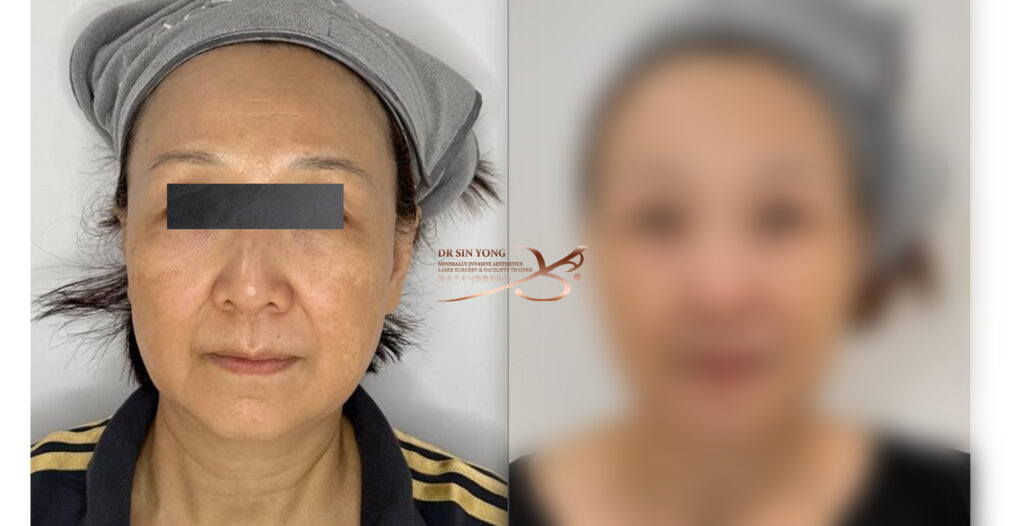 FSX Flawless Smooth Laser - Pores & Melasma Before and after