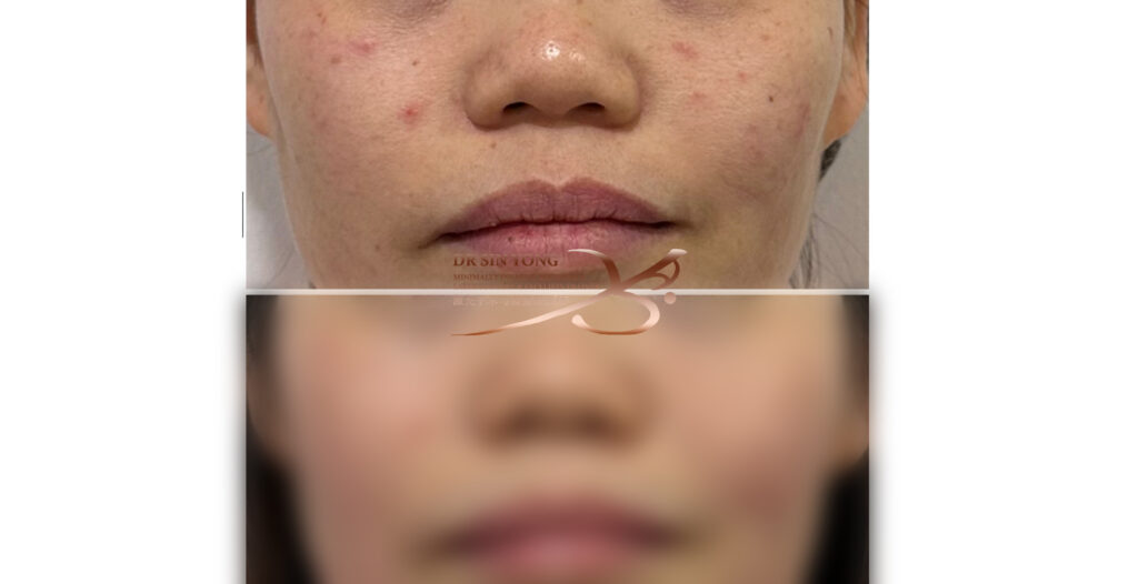 FSX Flawless Smooth Laser, Acne Treatment before and after