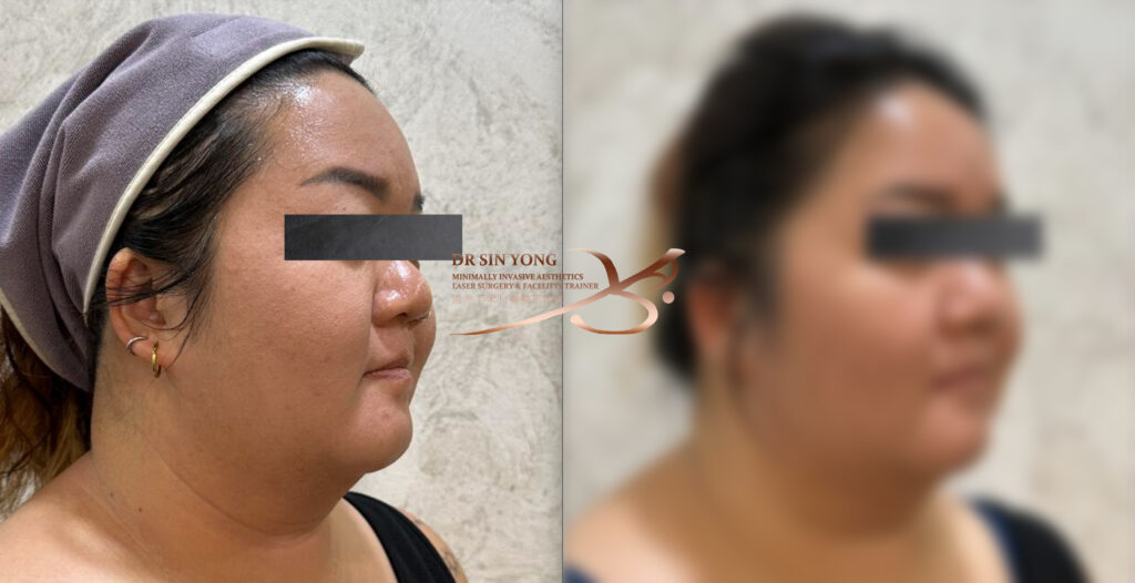 Tetra Pro Scar3 - Loose Neck - Neck Lift Treatment Jawline Definition