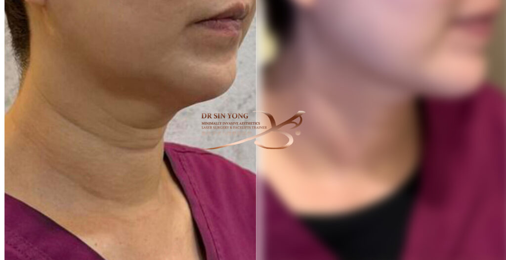 Tetra Pro Scar3 - Loose Neck - Neck Lift Treatment Jawline Definition