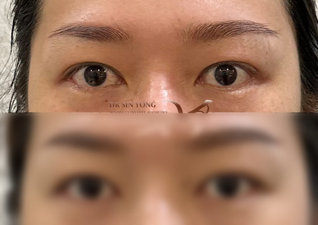 FSX Flawless Smooth Laser - Non Surgical Blepharoplasty Eye Lift For Droopy Eyelids